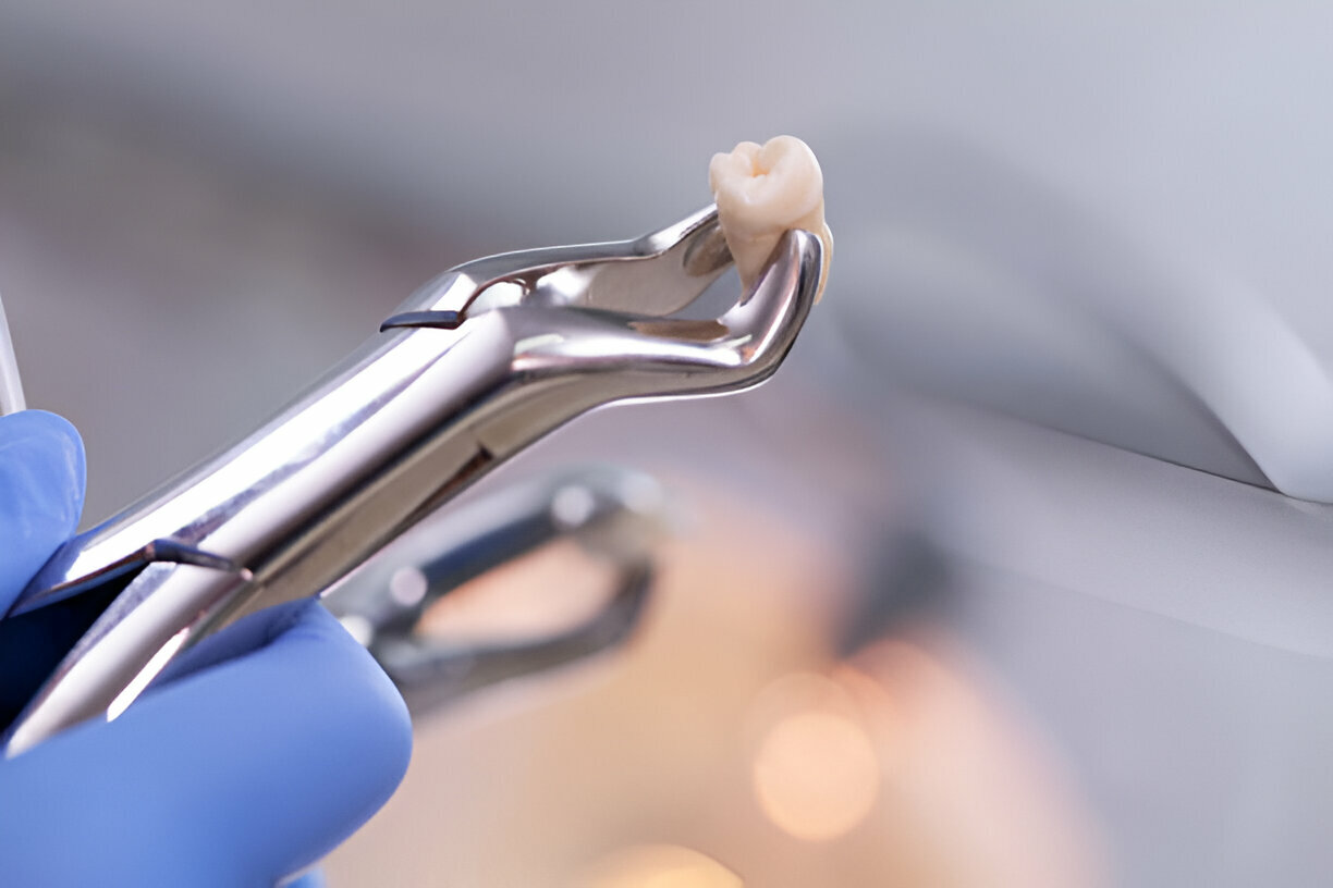 Teeth Extractions and Pain Management: Tips for a Smooth Recovery_3