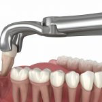 Teeth Extractions and Pain Management: Tips for a Smooth Recovery_FI