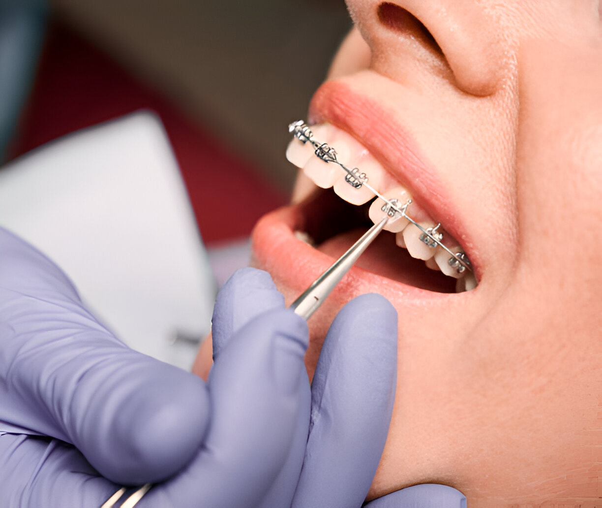 How to Choose the Right Orthodontic Treatment for Your Smile_1