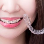 How to Choose the Right Orthodontic Treatment for Your Smile_FI