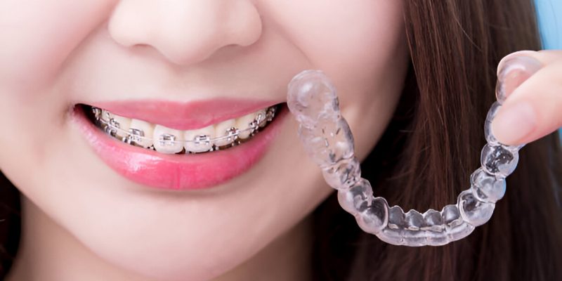 How to Choose the Right Orthodontic Treatment for Your Smile_FI