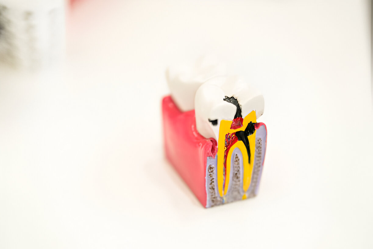 What to Expect from Root Canal Specialists in San Antonio, TX: Insights from Heritage Dental_1